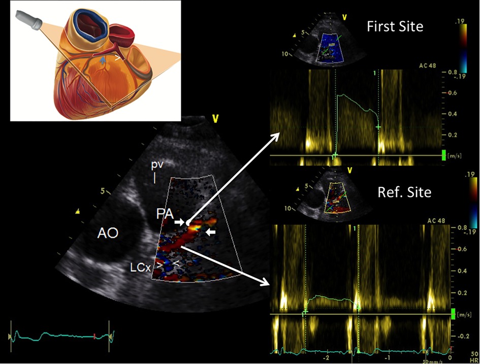 Frontiers  Accelerated stenotic flow in the left anterior descending  coronary artery explains the causes of impaired coronary flow reserve: an  integrated transthoracic enhanced Doppler study
