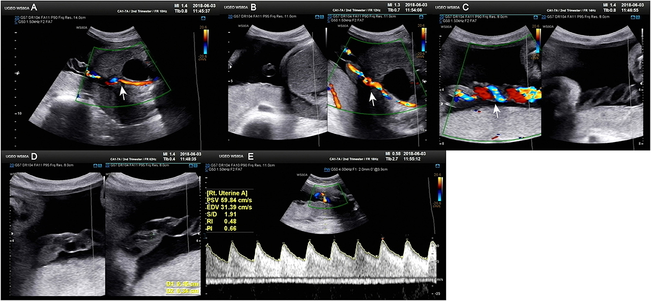 Frontiers  Umbilical artery thrombosis and maternal positive