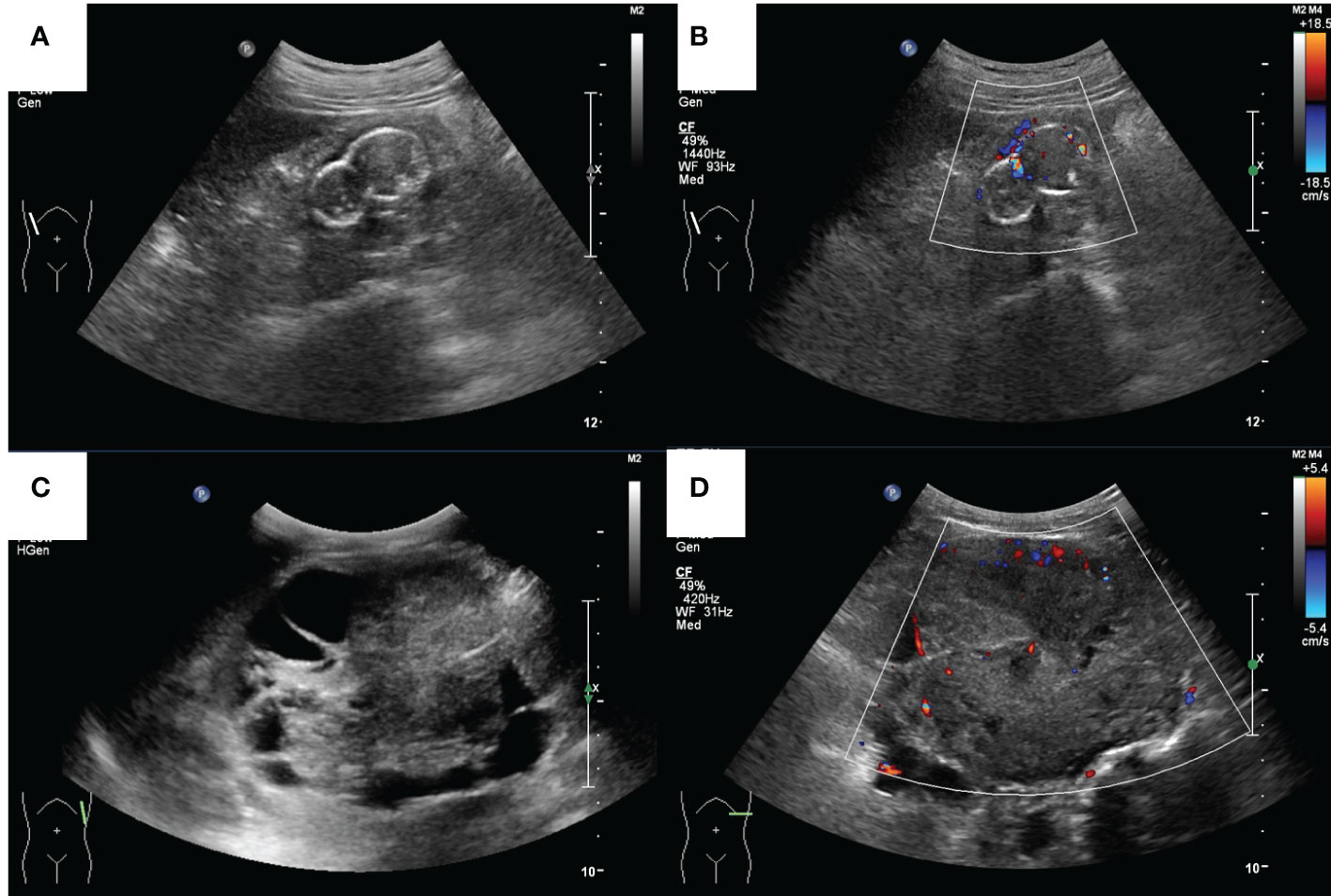 Frontiers | Case Report: The ultrasound features of acquired cystic ...