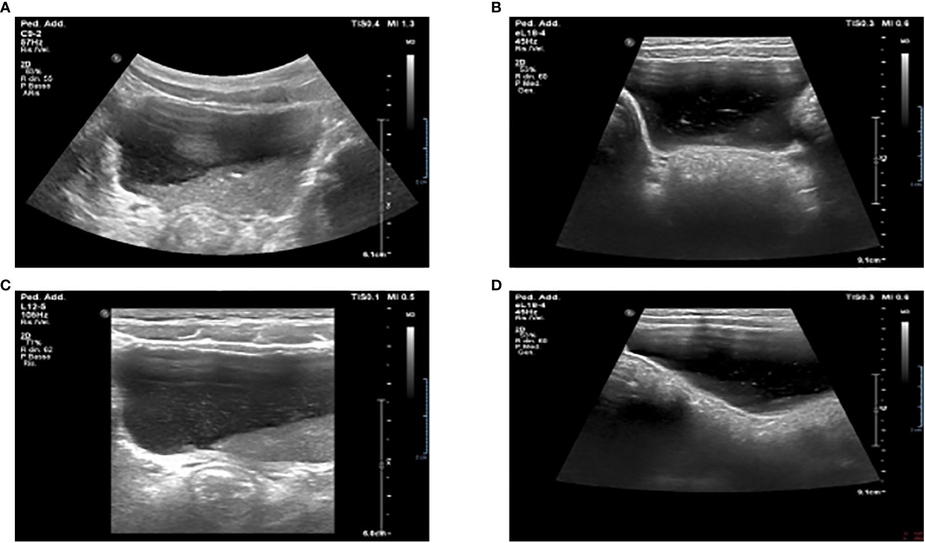 Frontiers | Case Report: Multisystem Inflammatory Syndrome In Children ...