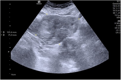 Frontiers  Case report: Ectopic pregnancy in the interstitial