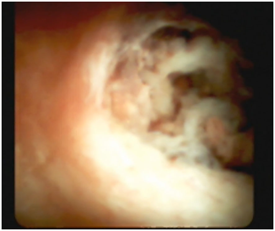Frontiers  Role of peroral cholangioscopy and pancreatoscopy in the  diagnosis and treatment of biliary and pancreatic disease: past, present,  and future