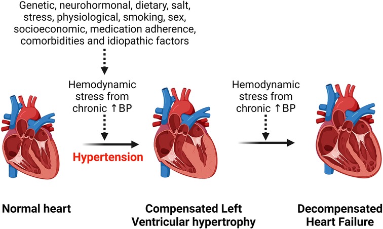 Hypertension and heart disease