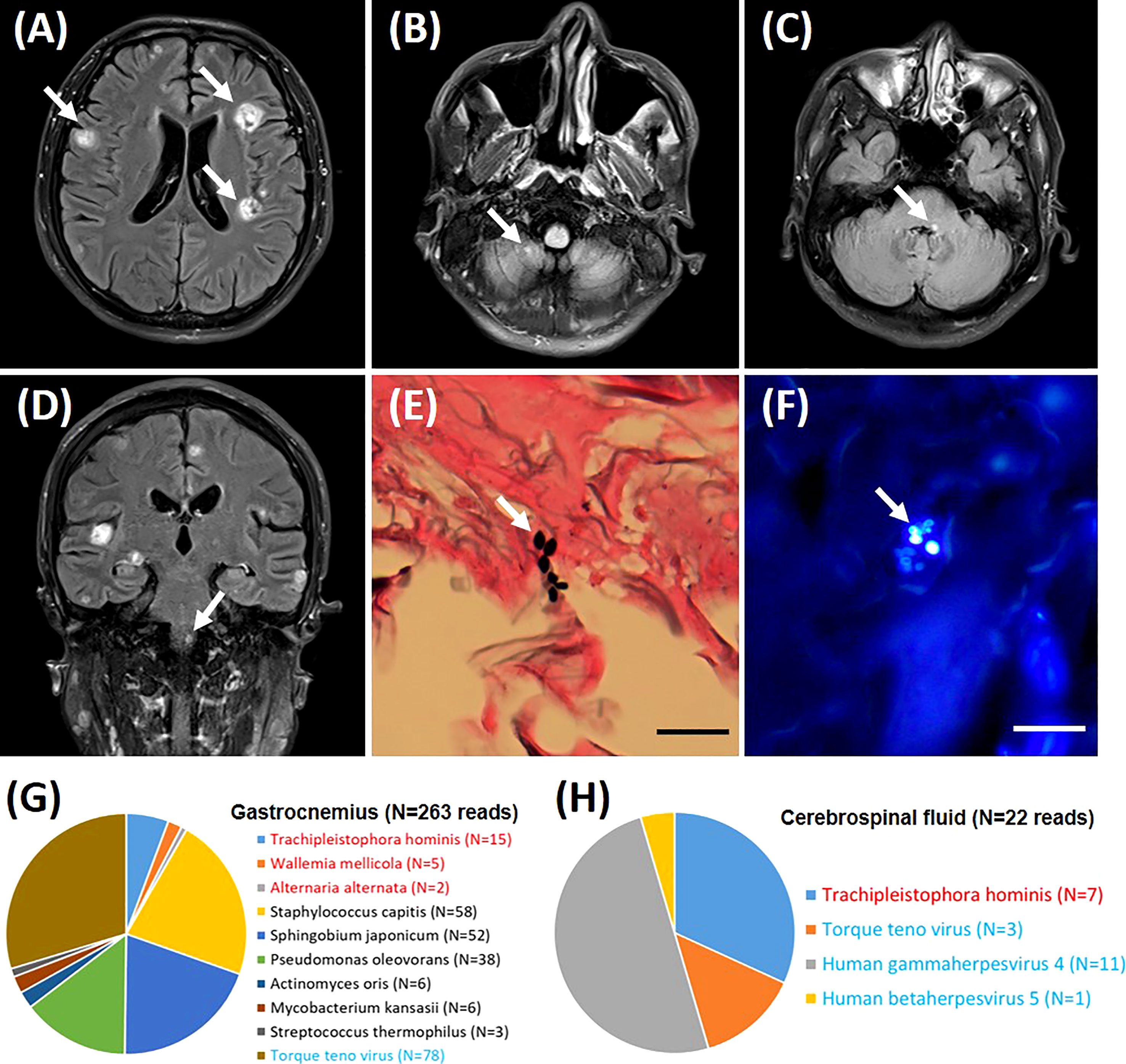 Frontiers Encephalitis and myositis caused by Trachipleistophora