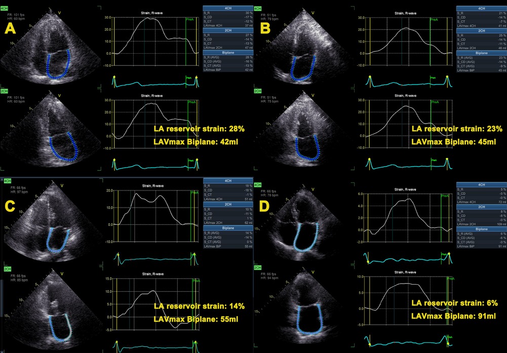Evaluation of left ventricular strain in patients with arrhythmia