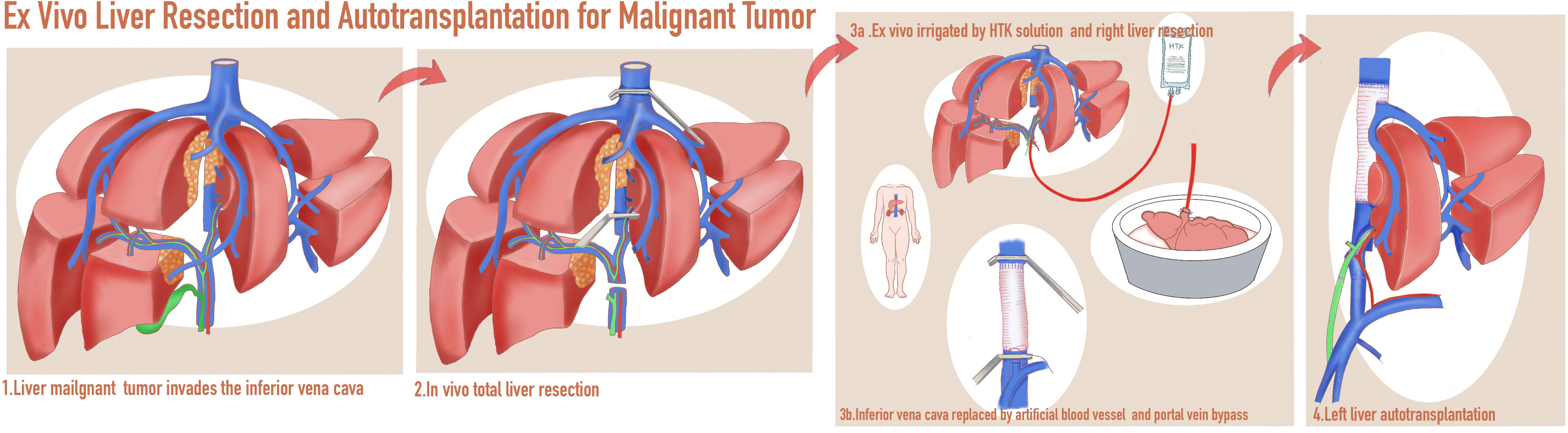 Frontiers | In vivo total or partial hepatectomy followed by ex vivo ...