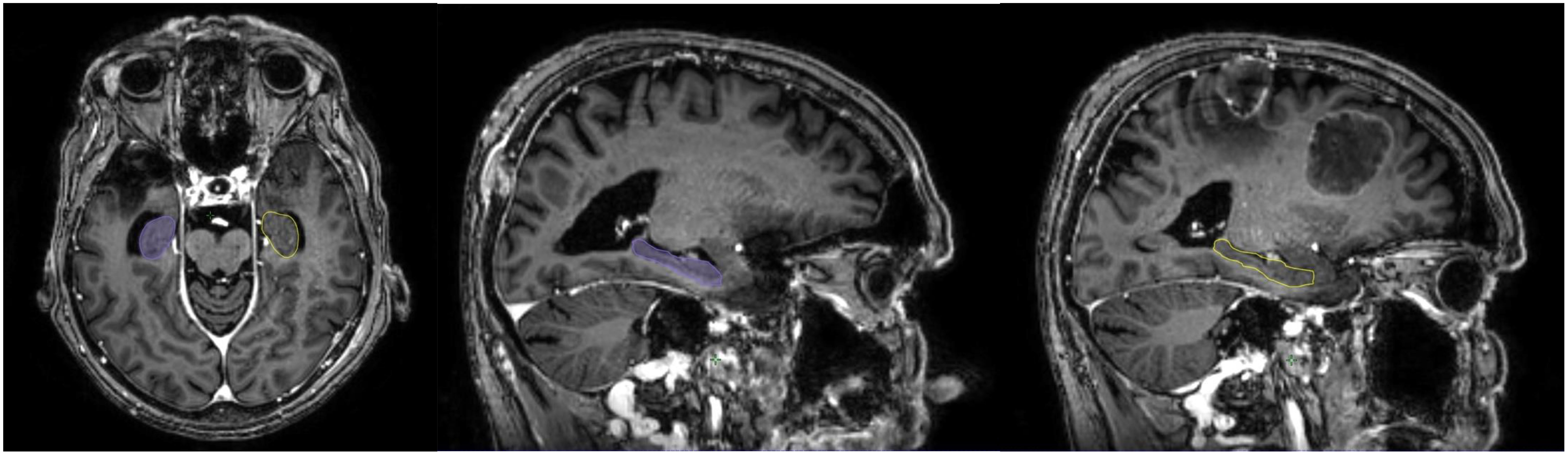 Frontiers | Neurotoxicity-sparing radiotherapy for brain metastases in ...