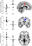 Frontiers | Functional and Structural Alterations in the Cingulate ...