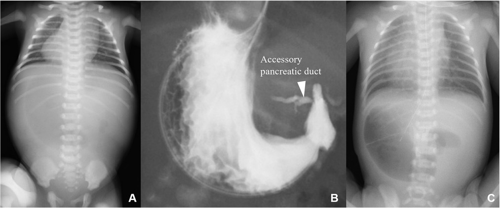 annular pancreas double bubble