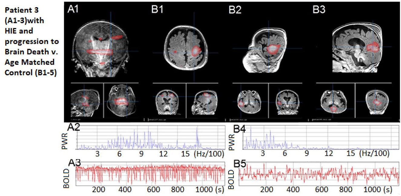 Frontiers | Treatable brain network biomarkers in children in coma 