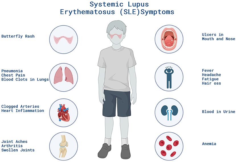 Systemic Lupus Erythematosus: When the Body Attacks Itself · Frontiers ...