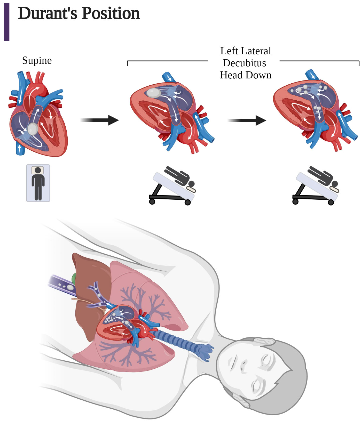 Risk of embolism from air bubble in IV line is minimal