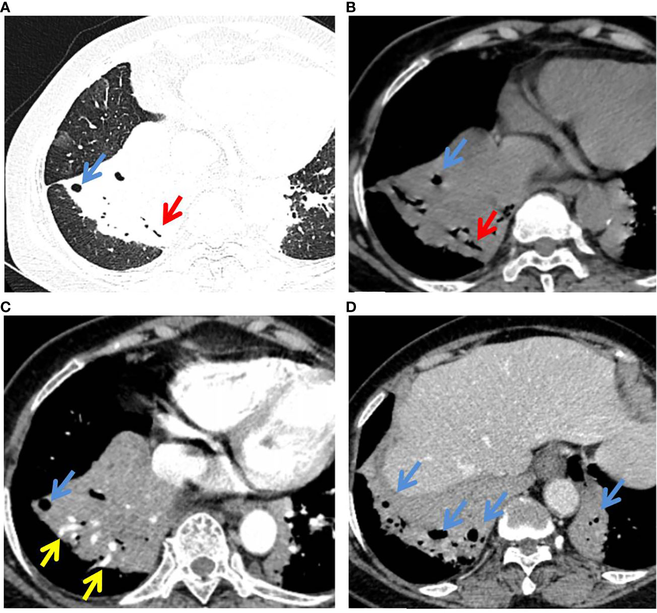 Frontiers | Evaluation of CT features for differentiating consolidation ...