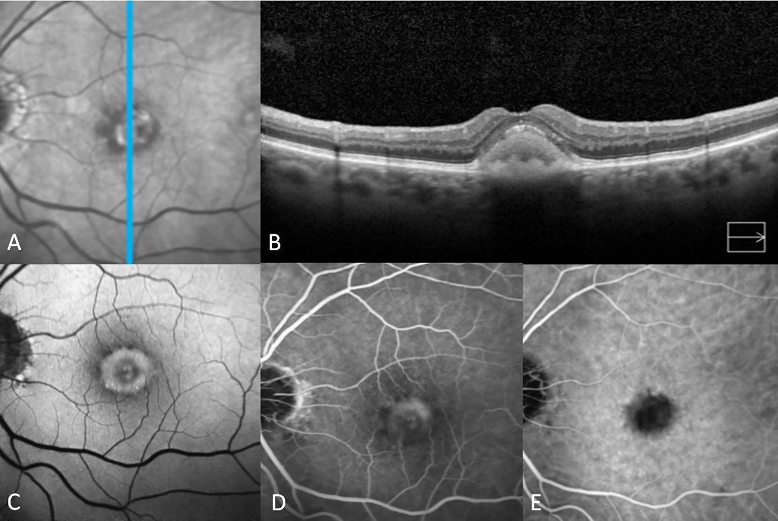 Frontiers | Adult-onset foveomacular vitelliform dystrophy ...