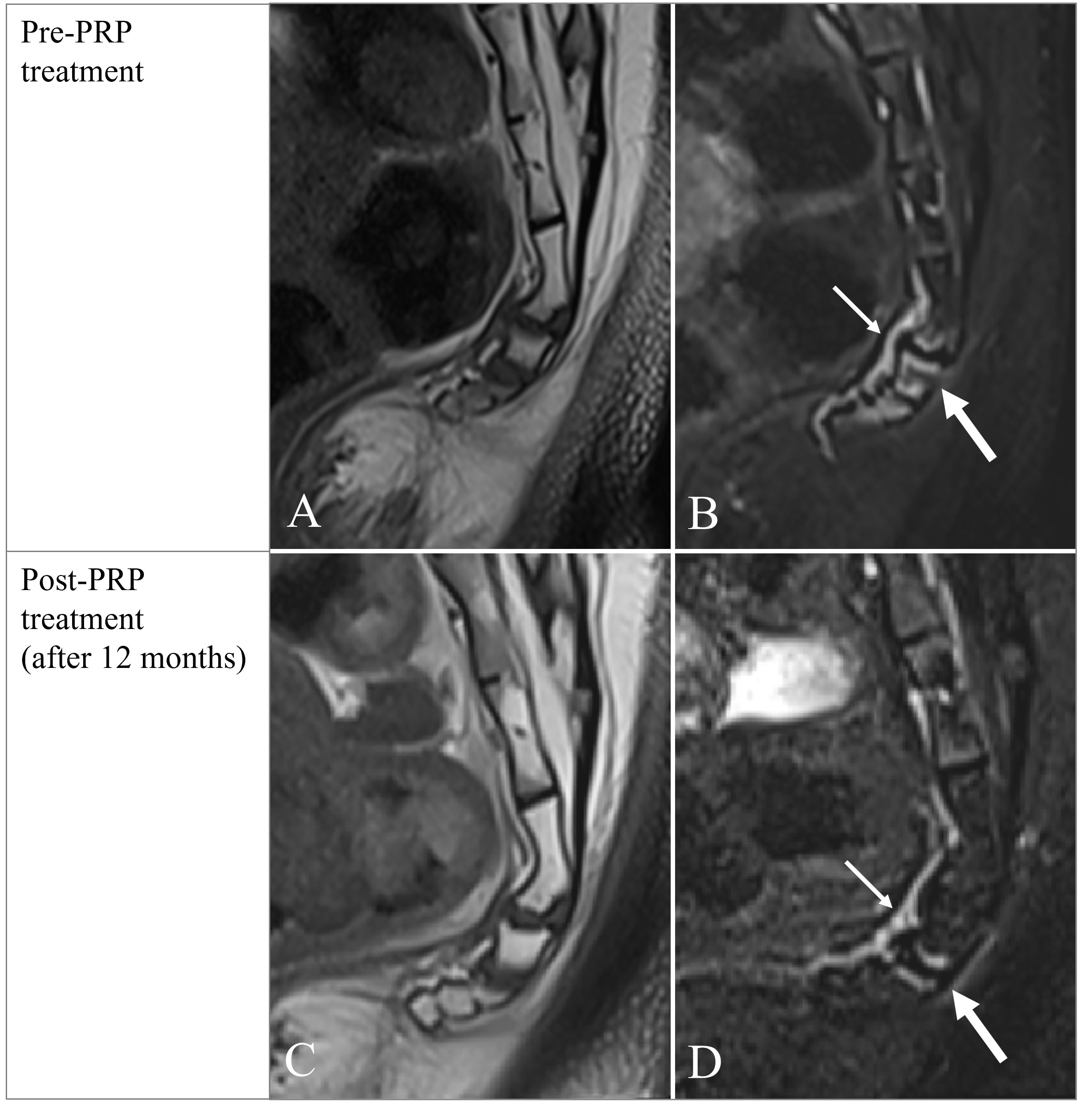 Coccydynia Diagnosis & Treatments