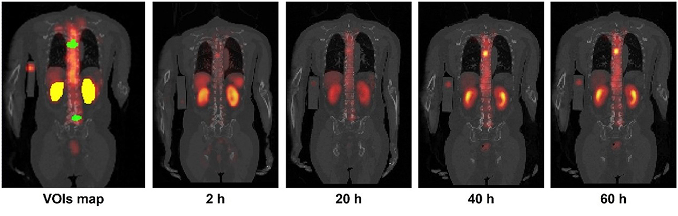 Frontiers  Lu-177-PSMA dosimetry for kidneys and tumors based on SPECT  images at two imaging time points