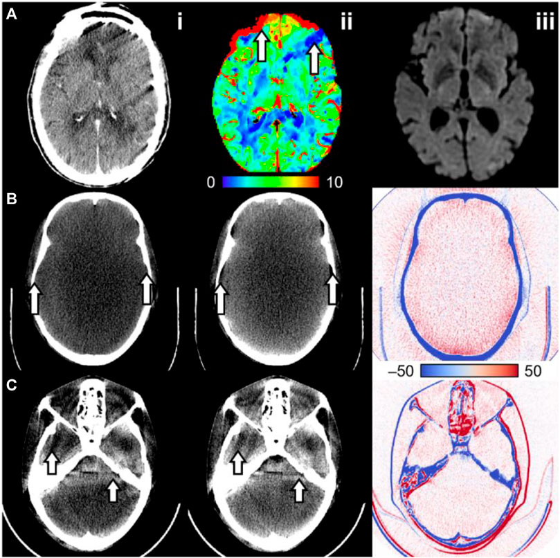 Frontiers | Quantitative functional imaging with CT perfusion 