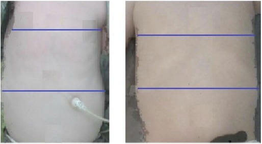 Bell-shaped chest is demonstrated with small upper chest. Musculature