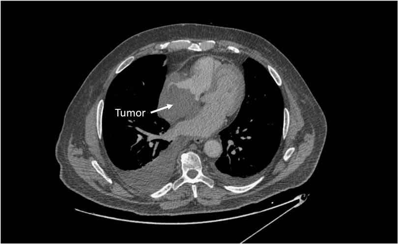 Frontiers | Case report: Primary cardiac lymphoma manifesting as 