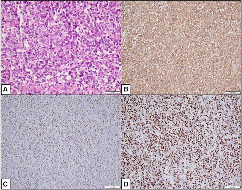 Frontiers | Case report: Primary cardiac lymphoma manifesting as 