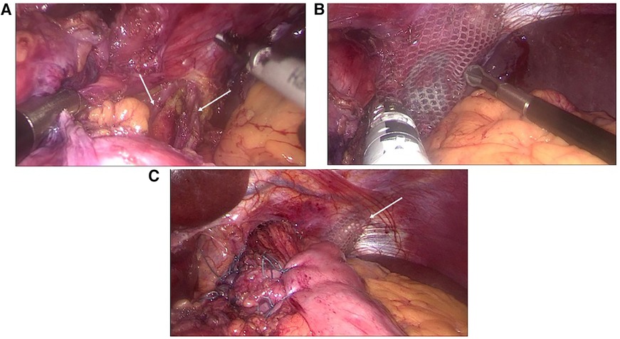 Frontiers  The value of “diaphragmatic relaxing incision” for the  durability of the crural repair in patients with paraesophageal hernia: a  double blind randomized clinical trial