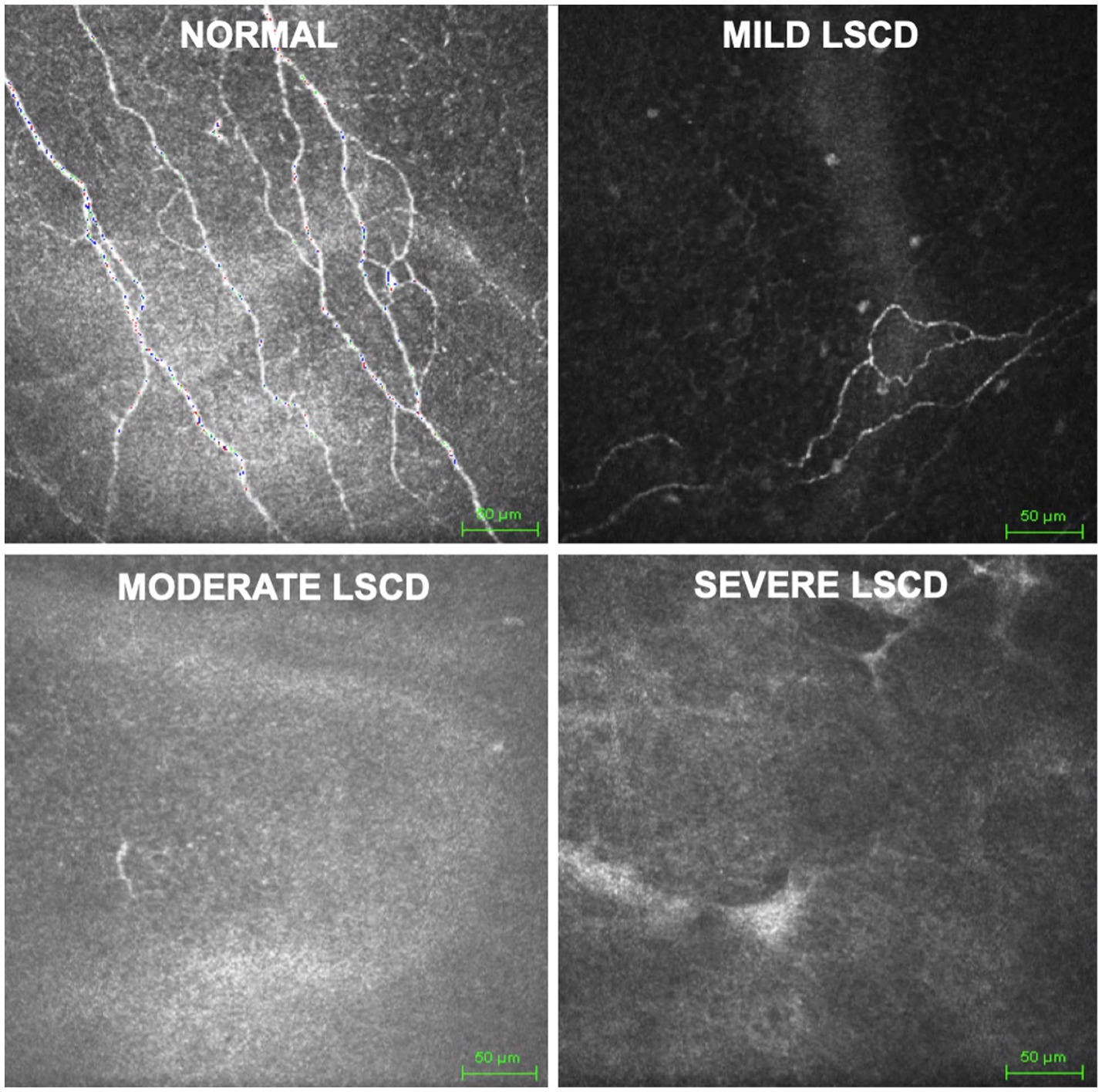 Frontiers  Latent diffusion augmentation enhances deep learning analysis  of neuro-morphology in limbal stem cell deficiency