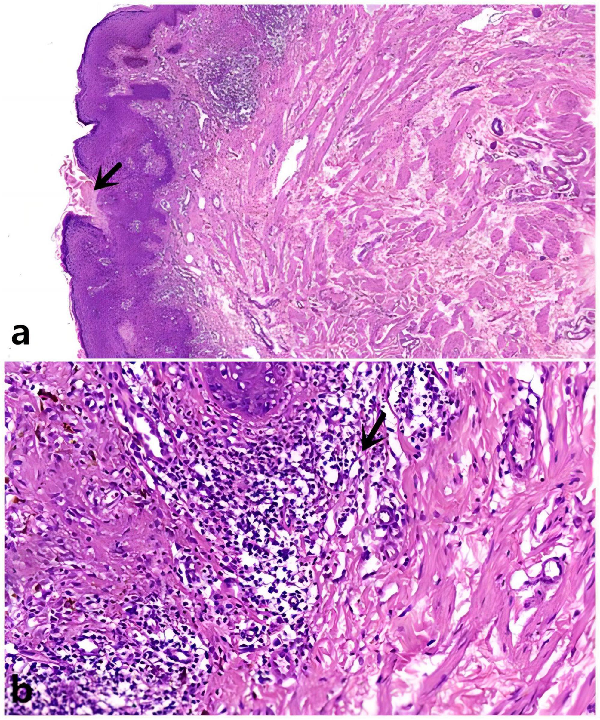 Frontiers | Porokeratosis of the scrotum: a case report and literature ...