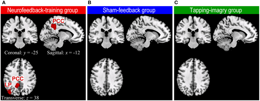 Is Neurofeedback-based Brain training the same as electroshock therapy?” -  ECT