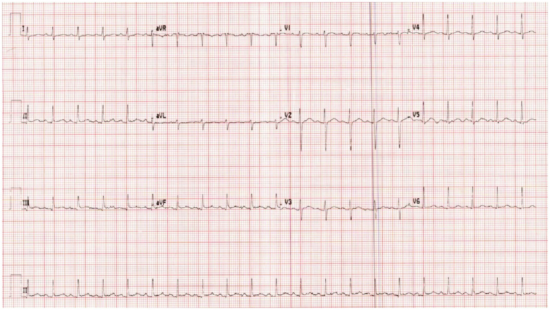 Clinical Challenge: Unexplained Tachycardia in 24-Year-Old Woman