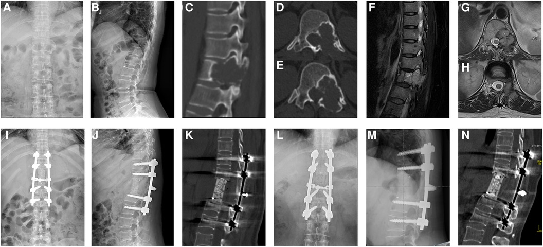 X Ray Dorso-lumbar Spine Lateral View shows bridging os