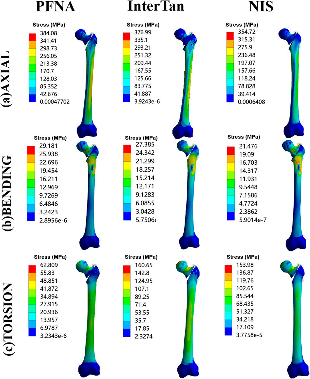 Frontiers | Biomechanical evaluation of three implants for treating ...