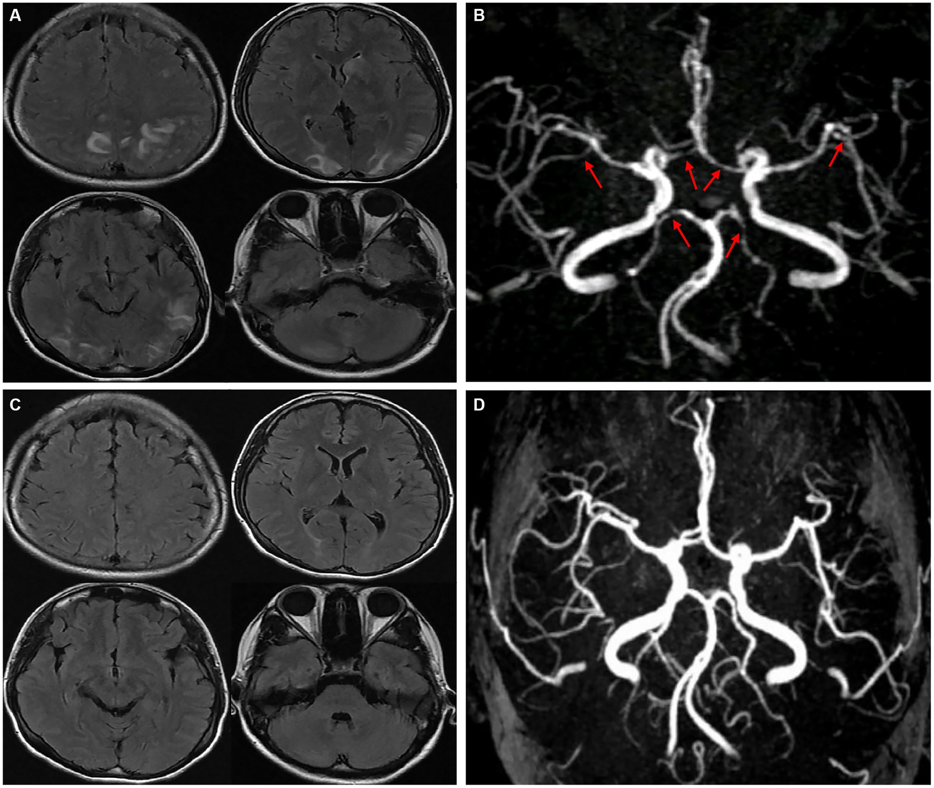 Frontiers | Reversible cerebral vasoconstriction syndrome 