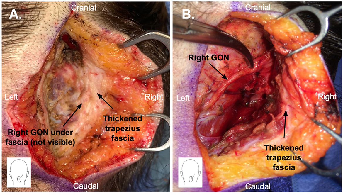 Sciatic Nerve Decompression: Background, Indications, Technical  Considerations