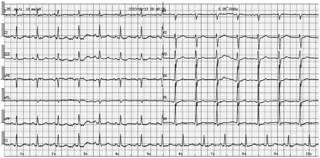 Frontiers | Case Report: Flurbiprofen-induced Type I Kounis syndrome