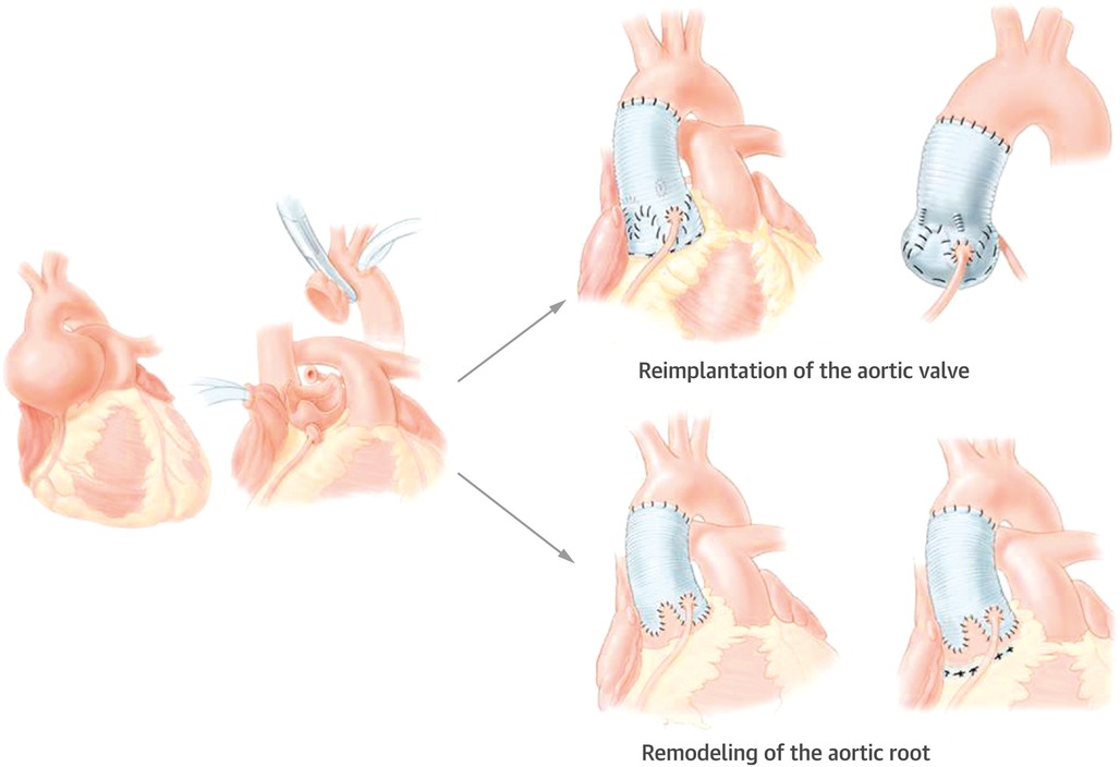Frontiers Bicuspid Aortic Valve Repair—current Techniques Outcomes Challenges And Future