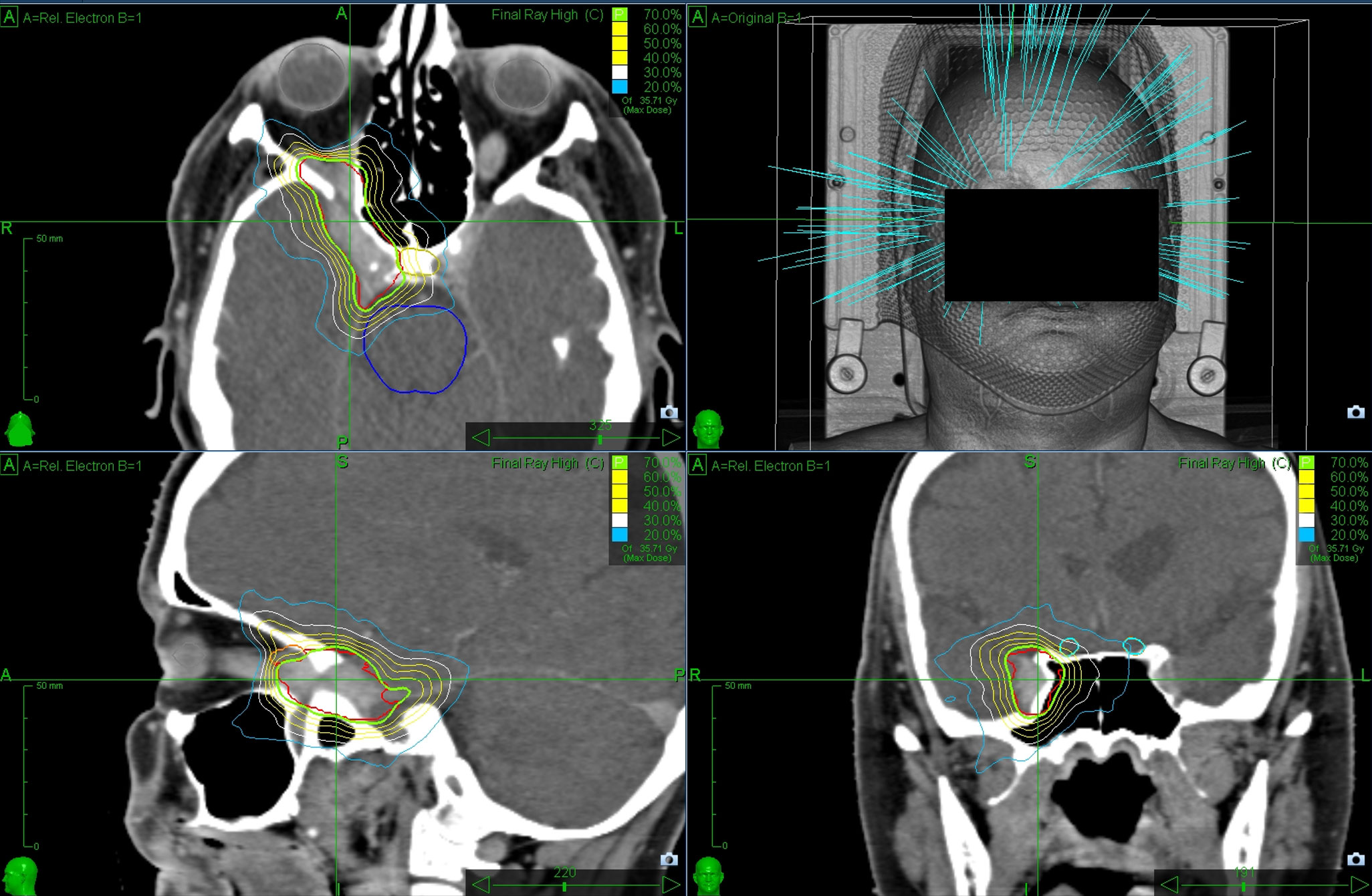 Frontiers | Robotic stereotactic radiosurgery for intracranial 