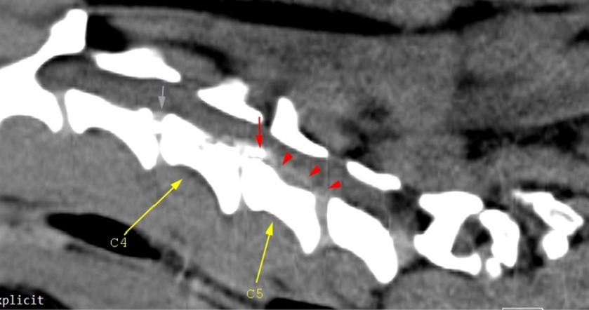 Frontiers | Case report: Double adjacent ventral slot in two medium ...