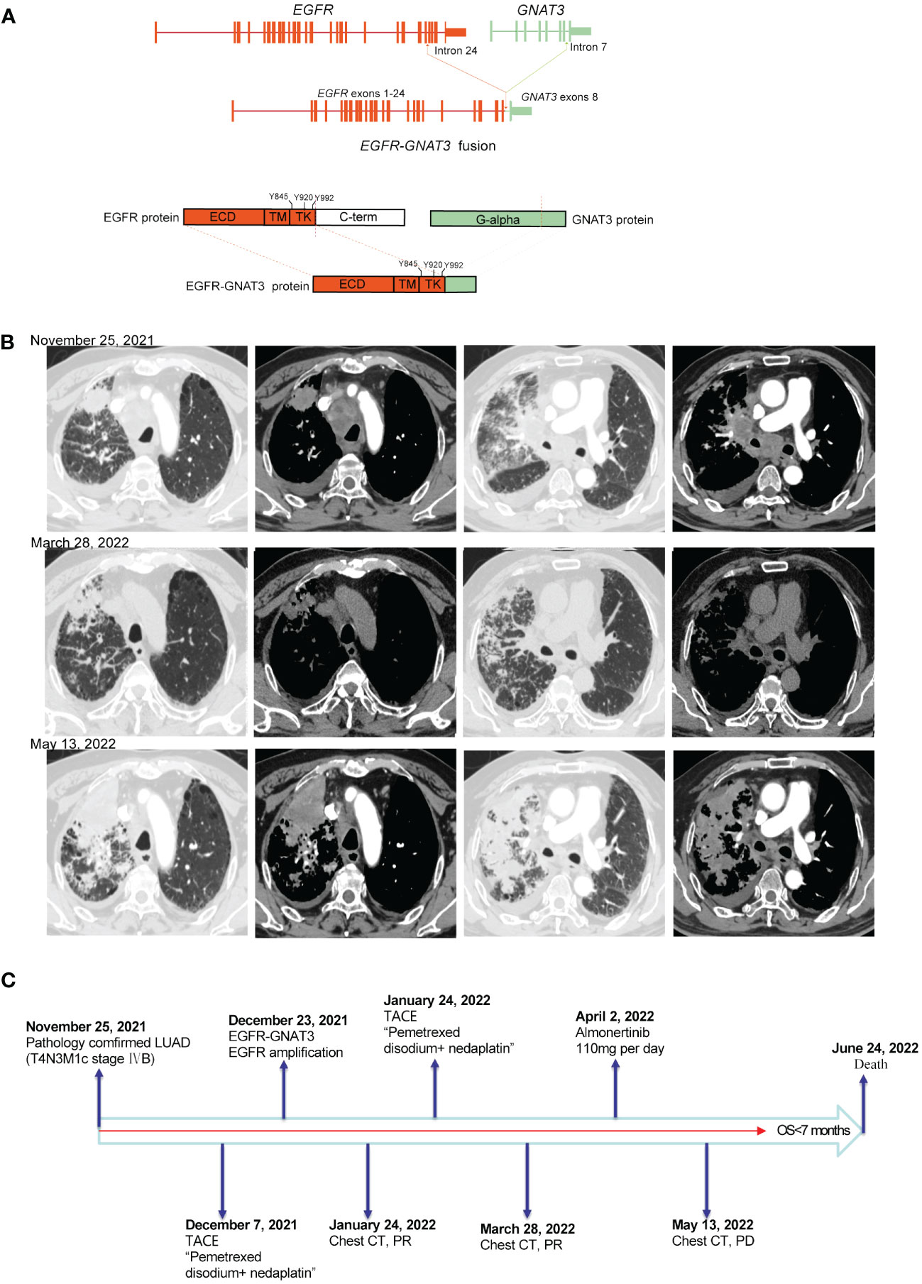 Frontiers | Case report: EGFR fusion mutation combined with EGFR ...