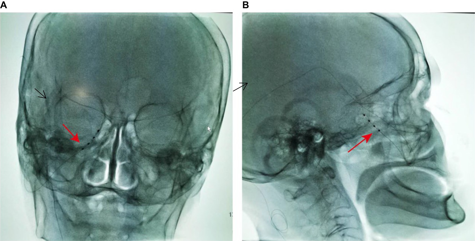 Frontiers  Case report: Use of peripheral nerve stimulation for
