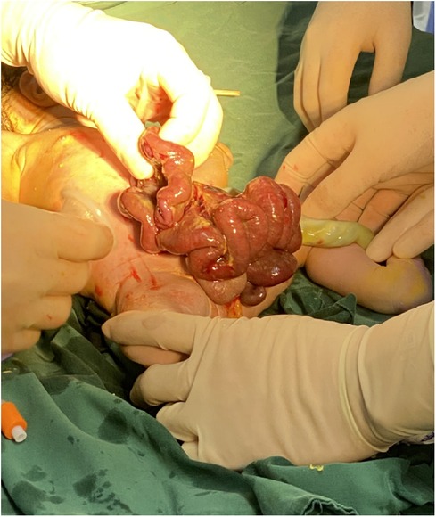 Facts about Gastroschisis