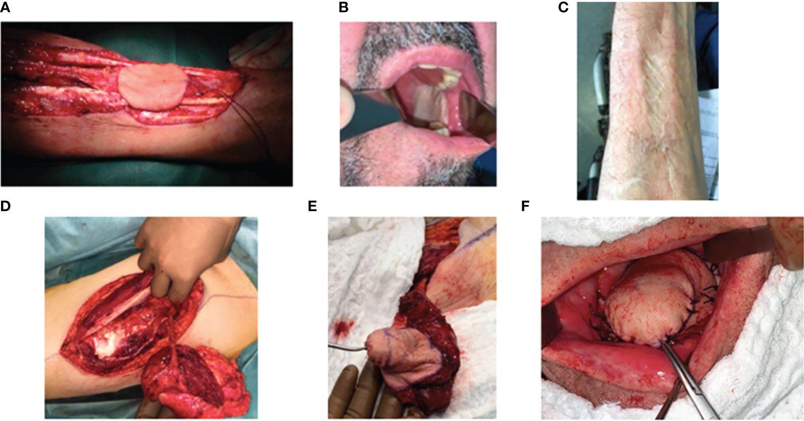 Frontiers | Reconstructive flap surgery in head and neck cancer 