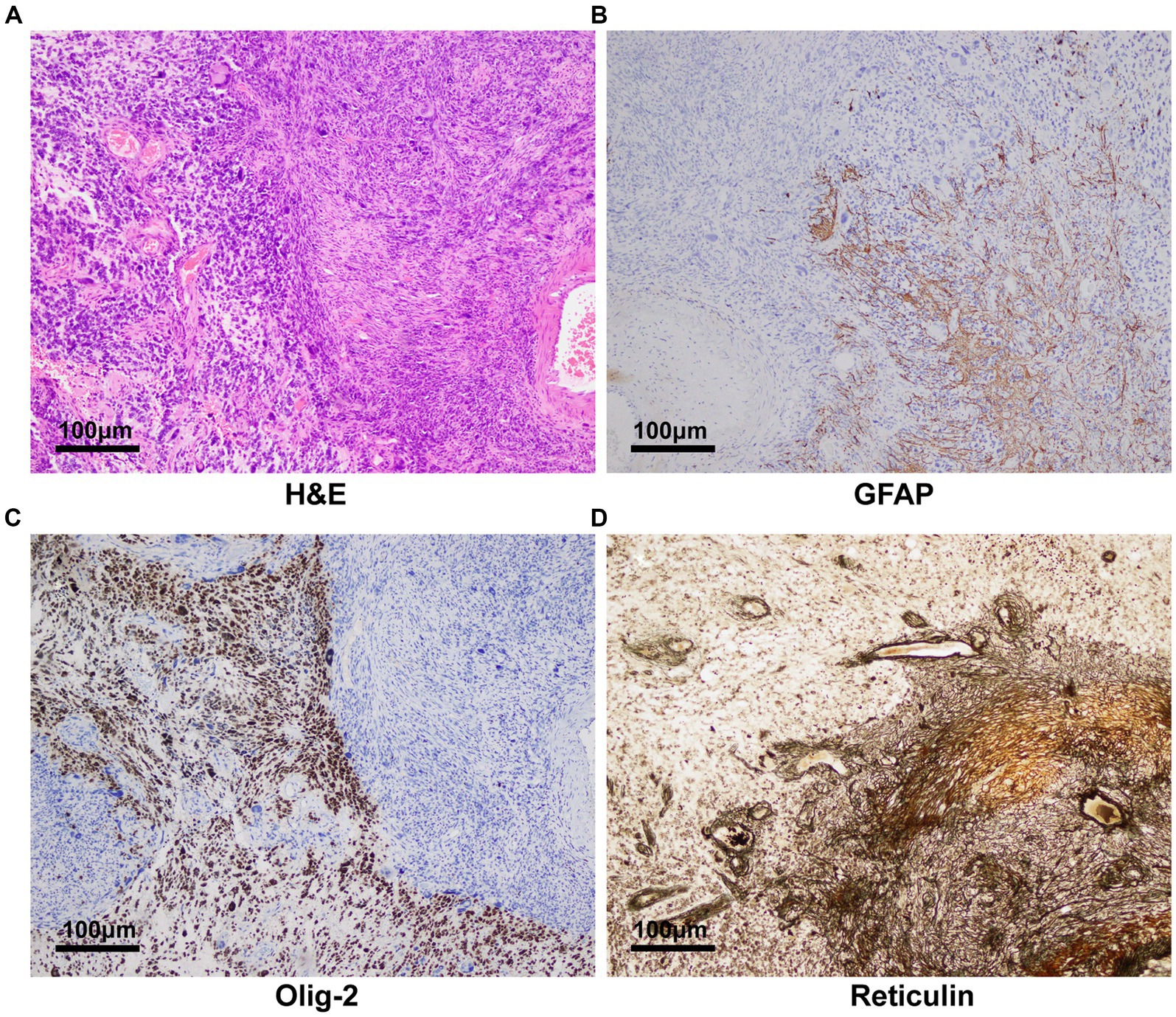 Frontiers | A case report: Gliosarcoma associated with a germline 