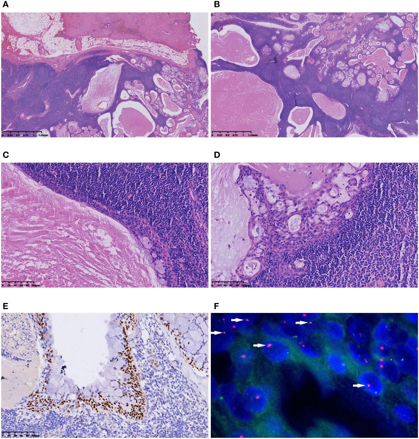 Frontiers | Case report: The diagnostic pitfall of Warthin-like ...