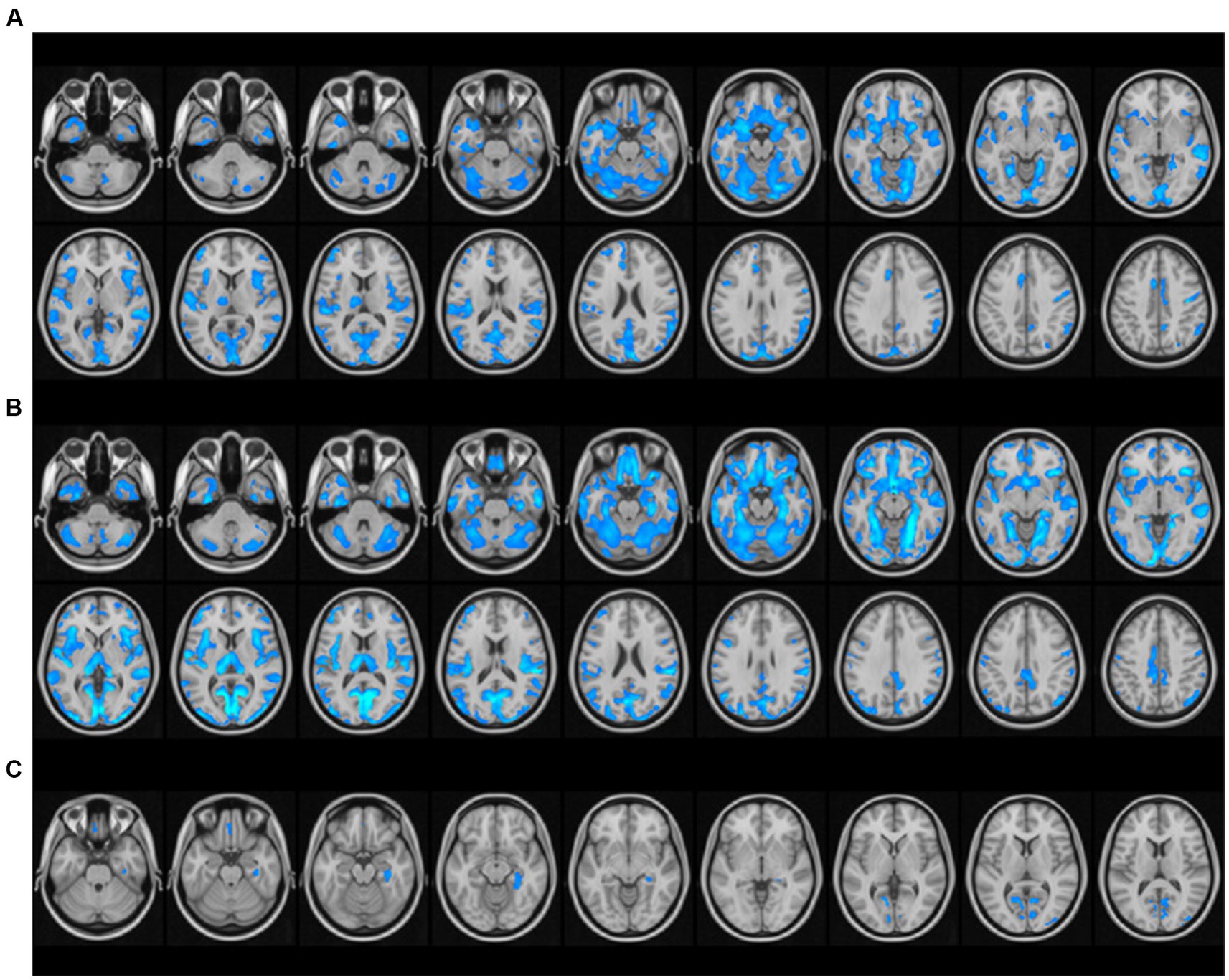 Frontiers | Comparison of brain gray matter volume changes in ...