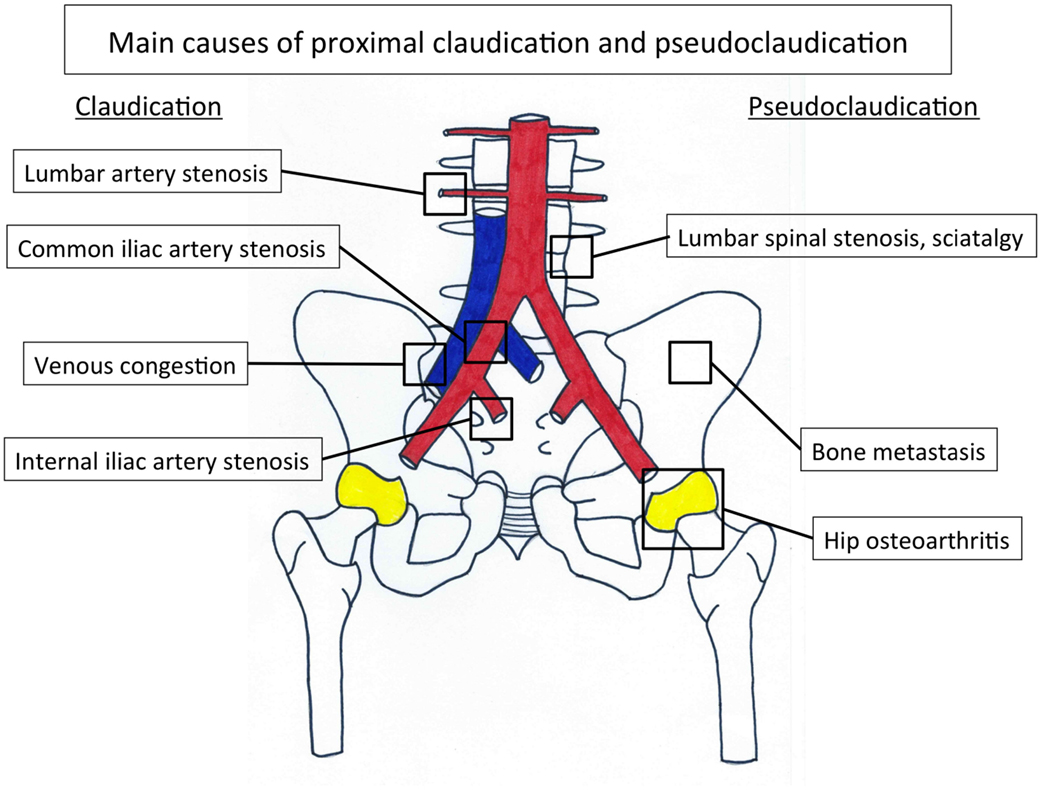 Frontiers | Internal Iliac Artery Stenosis: Diagnosis and How to Manage ...