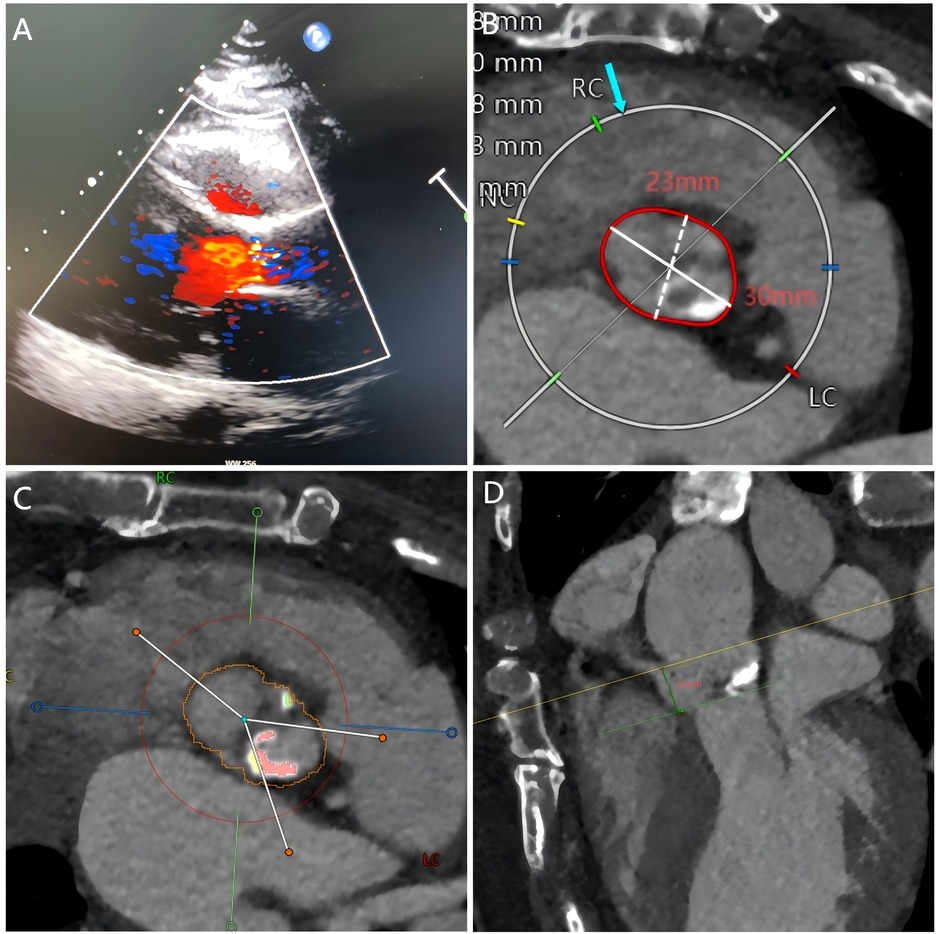 Frontiers | Case Report: The second valve drag technique for managing ...