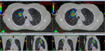 Frontiers | Treatment Plan Technique and Quality for Single-Isocenter ...