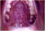 Frontiers | Clinical Appearance of Oral Candida Infection and ...