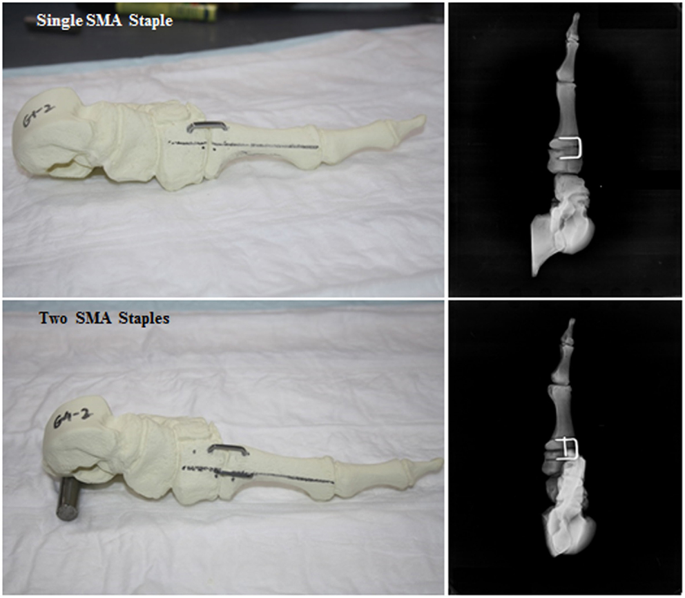 Nitinol Staples System - TriMed Inc.