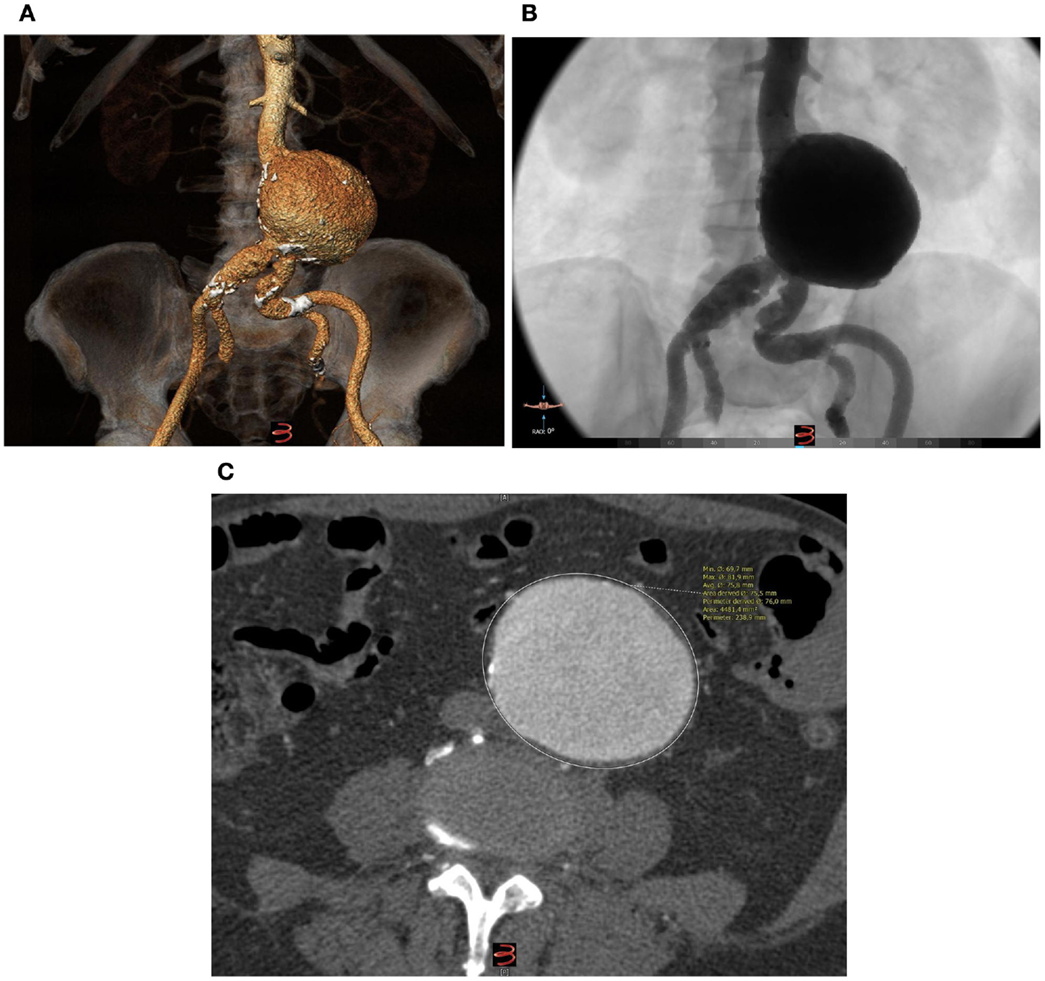 Frontiers | Non-Invasive Pulse Wave Analysis in a Thrombus-Free Abdominal Aortic Aneurysm after ...